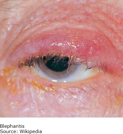 Picture of Blepharitis