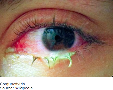 Picture of Conjunctivitis