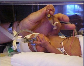 photo_of_intubated_baby
