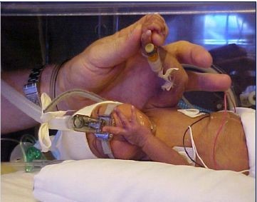 Image 3 Intubated baby