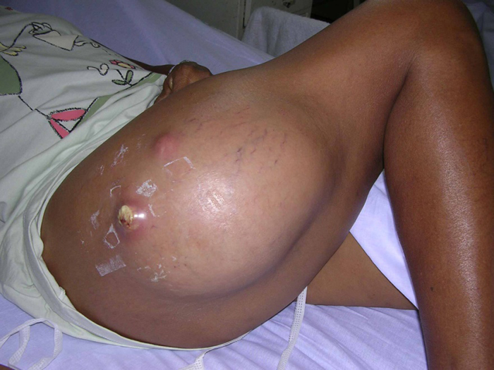 Photo of Skin and Soft Tissue Infections