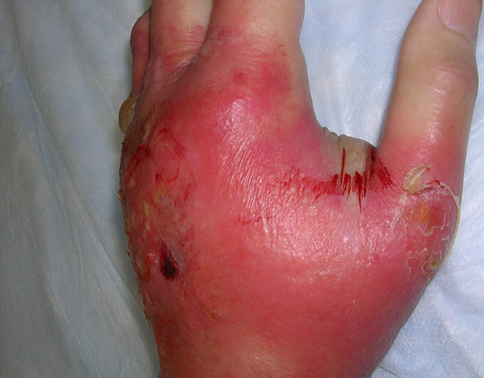 Photo of Skin and Soft Tissue Infections