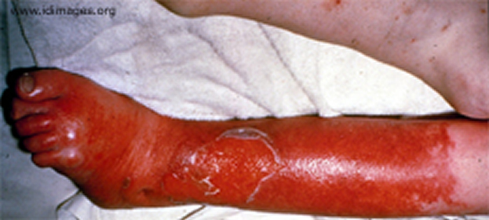 Photo of Skin and Soft Tissue Infections